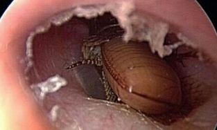 Quảng Ninh: Người đàn ông bị gián chui vào tai khi ngủ