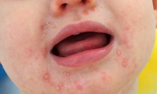 TPHCM: Bệnh chân tay miệng tăng vọt 