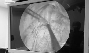 Phú Thọ: Bệnh nhi 9 tuổi có ruột non nằm trên khoang màng phổi