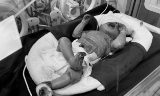 Quảng Ninh: Bé trai mắc bệnh da vảy cá tiên lượng nặng