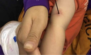 Dỗ em, anh trai 12 tuổi làm nan ô che mưa đâm xuyên cánh tay em bé 6 tháng