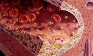 Người Việt ngày càng thừa mỡ máu do ăn nhiều cơm