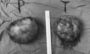 Bầu ngực biến dạng hoàn toàn sau khi đặt túi ngực nhân tạo