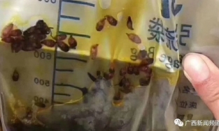 Cả đàn ký sinh trùng cư ngụ ở mật của người đàn ông 50 tuổi hay ăn cá sống