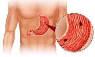 Quảng Ninh: Bé trai 11 tuổi bị thủng dạ dày do hay ăn cay