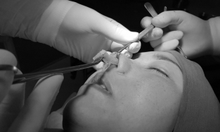 Nâng mũi bị thủng lại được tiêm kháng sinh vào mông