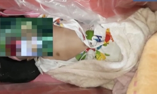 Vụ bé gái còn thở được đưa vào nhà hỏa táng: Bác sĩ nói gì?