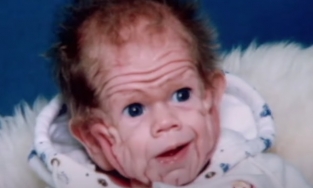 Cuộc sống của đứa trẻ sinh ra với chứng thừa da kỳ lạ, cả cơ thể chảy xệ