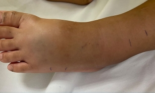 TP.HCM: Bé trai 4 tuổi bị rắn lục đuôi đỏ cắn