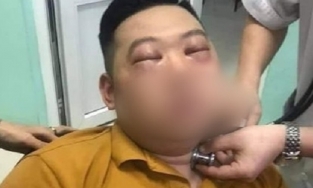 Sau khi thái hành, nam thanh niên bị sốc phản vệ nặng phải vào viện cấp cứu