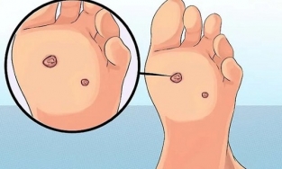 Dấu hiệu điển hình ở chân cảnh báo nguy cơ mắc ung thư cổ tử cung