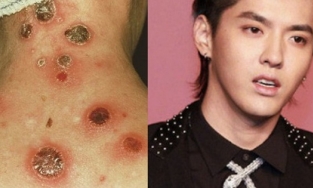 Bệnh giang mai mà Ngô Diệc Phàm bị đồn mắc phải nguy hiểm cỡ nào?