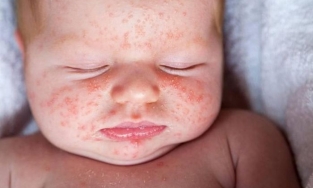 15% trẻ nhỏ có biểu hiện này khi nhiễm biến thể Omicron