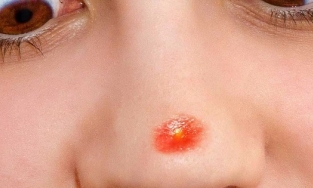 Nặn mụn ở vùng 'tam giác chết' trên mặt có thể gây nhiễm trùng não