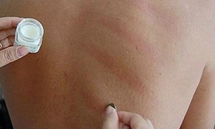 Người mắc Covid có nên cạo gió không?