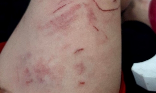 Bình Dương: Người dân bị đàn khỉ tấn công cào xé