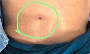 Hòa Bình: Người đàn ông bị suy đa tạng vì bị sốt mò