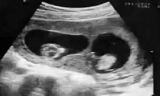 Hi hữu đứa bé sơ sinh có ADN giống chú ruột nhưng bố lại là con một