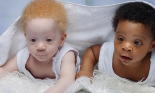 Cặp sinh đôi cùng trứng nổi tiếng vì có vẻ ngoài hoàn toàn khác nhau