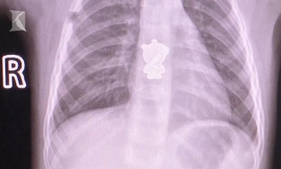 Bé gái ho ra máu vì nuốt phải hình dán heo Peppa