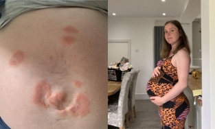 Người phụ nữ mắc bệnh dị ứng với đứa con của mình, cứ đứng gần là nổi mụn