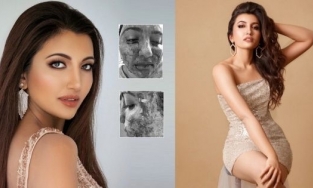 Shree Saini từng bị biến dạng khuôn mặt vì bỏng nặng trước khi trở thành tân Á hậu Miss World 2021
