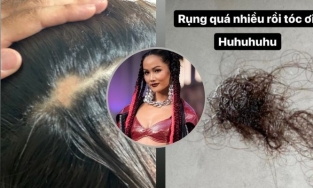 Top 5 Hoa hậu Hoàn vũ thế giới H'Hen Niê bị hói ở tuổi 30, khổ sở vì tóc rụng cả mảng