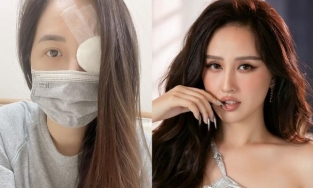 Fan lo lắng khi Mai Phương Thúy nhập viện với 1 bên mắt băng kín, hối hận vì tự chữa bệnh tại nhà