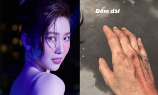 Thuý Ngân bất ngờ đăng ảnh tay bầm dập, nói 1 câu khiến fan lo lắng