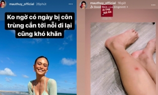 Đi nghỉ dưỡng sang chảnh, Mâu Thủy bị côn trùng cắn nổi “hoa” đầy chân, đi lại cũng khó khăn