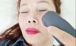 'Cô dâu 62 tuổi' điều trị méo miệng sau cuộc đại phẫu căng da mặt