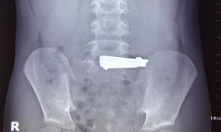 Phú Thọ: Bé trai 9 tuổi nuốt bấm móng tay vì bắt chước trên YouTube