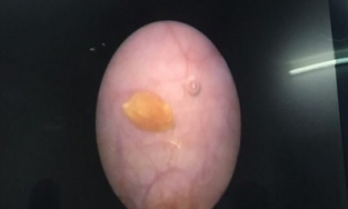 Chuyện hy hữu: Hạt thóc 'đi lạc' vào bàng quang của bé gái 26 tháng tuổi