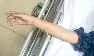 Quảng Ninh: Bé trai 6 tuổi bị que xiên thịt nướng đâm thủng cánh tay 