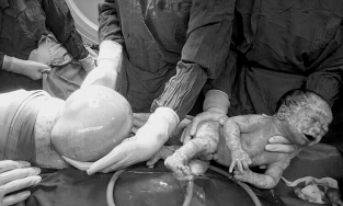 Hy hữu: Bé song sinh chào đời còn nguyên bọc ối hình trái tim