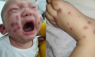 Việt Nam phát hiện và điều trị một ca bệnh cực hiếm, cả thế giới chỉ có 300-500 người.