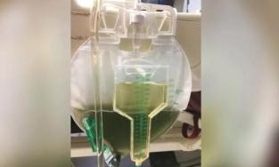 Kỳ lạ nước tiểu của bệnh nhân 62 tuổi chuyển màu xanh lá sau 5 ngày nằm viện