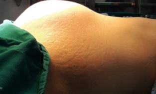 Hà Nội: Tưởng thai 9 tháng, hoá ra u xơ tử cung