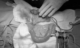 Lần đầu tiên ghép nối ruột tái tạo đường ăn cho bệnh nhân ung thư họng