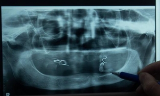 Hà Nội: Bệnh nhân mọc sỏi trong miệng