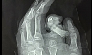 Hà Nội: Đút tay vào máy giặt, bé trai bị đứt ngón trỏ