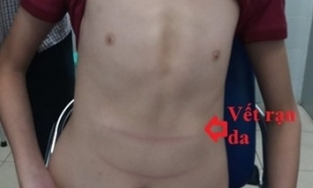 Thanh Hoá: Bé trai 11 tuổi cao 1m8, lồng ngực nhô ra như ức gà