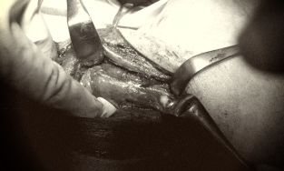 Phát hiện vi khuẩn kháng nhiều loại kháng sinh trong ổ áp xe giáp