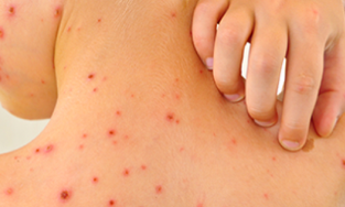 Phú Yên: Ghi nhận 2 trường hợp tử vong do sốt xuất huyết