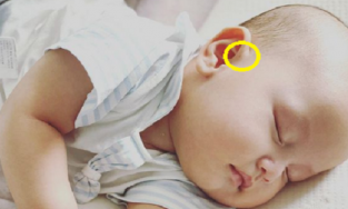 Rò luân nhĩ: Dị tật bẩm sinh mà hai con trai của Hồ Ngọc Hà mắc phải là bệnh gì?