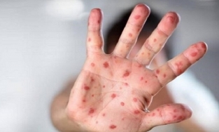 Bệnh nhi tay chân miệng tăng vọt, 4 ca tử vong, Bộ Y tế có công văn khẩn