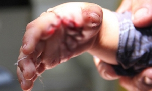 Bạc Liêu: Bé trai 34 tháng tuổi bị cá sấu tấn công