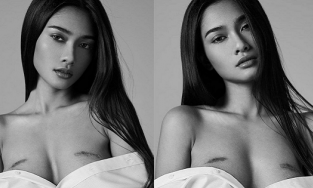 Hoa hậu Myanmar - đối thủ mà Khánh Vân giúp đỡ - có hai vết sẹo lớn ở ngực