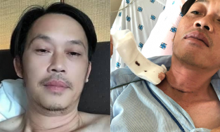Dân mạng soi ra điểm bất thường vào ngày Hoài Linh phẫu thuật K tuyến giáp
