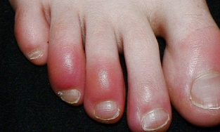 Chuyên gia y tế thế giới cảnh báo triệu chứng mới của người nhiễm Covid-19